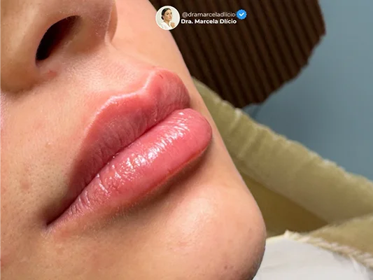 Preenchimento Labial — La Pie