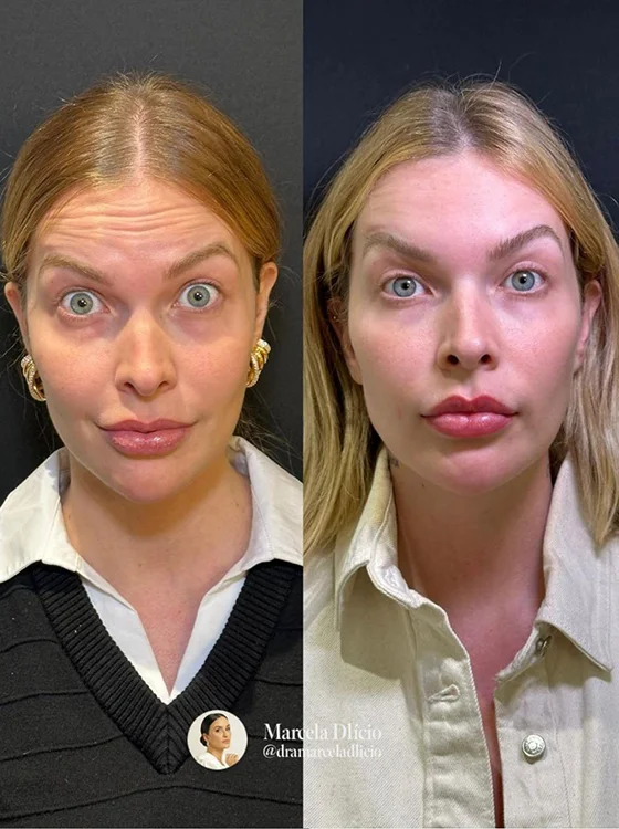 Resultado Toxina Botulínica — antes e depois