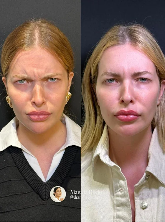 Resultado Toxina Botulínica — antes e depois