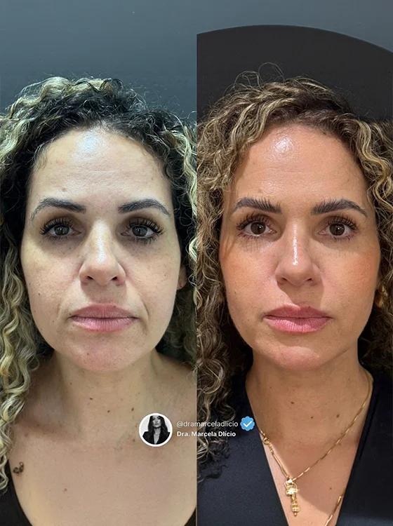 Resultado Sculptra — antes e depois